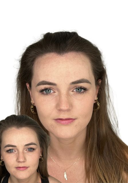 Hairline restoration result for a female client