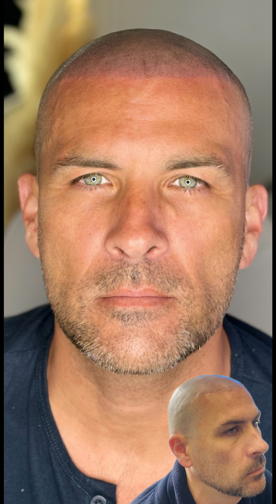 Front hairline restoration for a male client