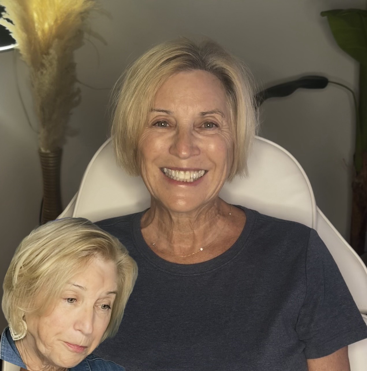 Restored hairline and brow softening for a mature female client