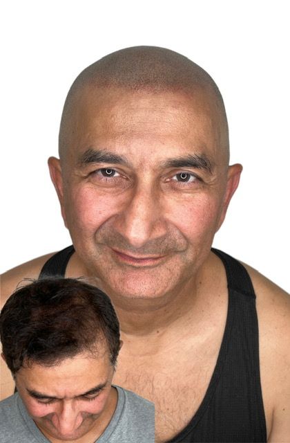 Full scalp micropigmentation result for a male client
